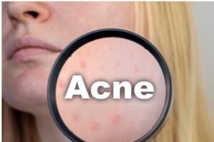 Suggested For The Acne