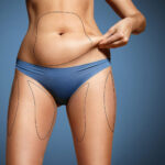 Precision and Poise: The Evolution of Liposuction in Dubai