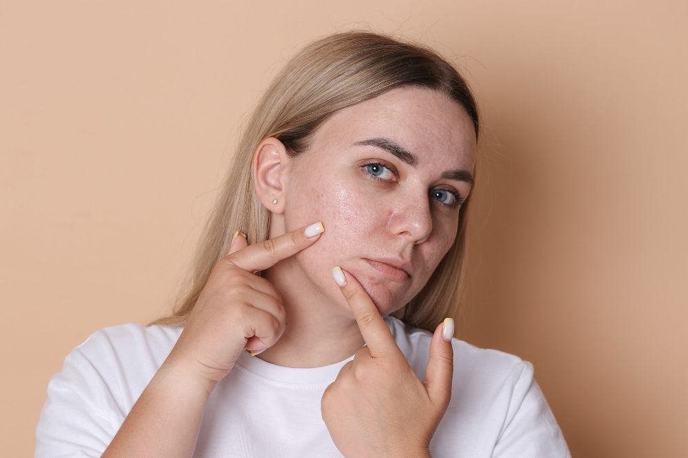 Tips For Acne-Prone Skin